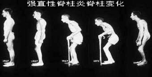 强直性脊柱炎的典型症状.jpg 强直性脊柱炎的典型症状.jpg