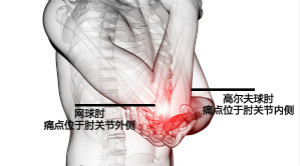 网球肘症状.jpg 网球肘症状.jpg