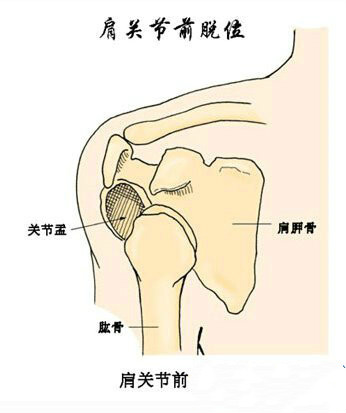 习惯性肩关节脱位手术治疗.jpg 习惯性肩关节脱位手术治疗.jpg