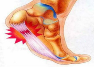 跟腱炎的治疗 (2).jpg 跟腱炎的治疗 (2).jpg