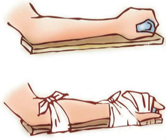 四肢骨折的急救方法.jpg 四肢骨折的急救方法.jpg