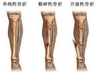 骨折病因.jpg 骨折病因.jpg