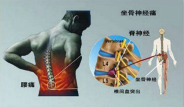 腰痛2.jpg 腰痛2.jpg