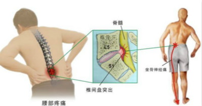 腰间盘突出1.jpg 腰间盘突出1.jpg