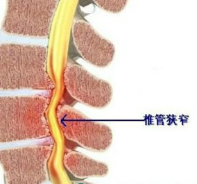 椎管狭窄的三大危害.jpg 椎管狭窄的三大危害.jpg