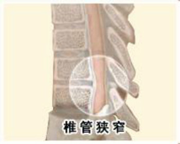 滑脱性椎管狭窄.jpg 滑脱性椎管狭窄.jpg