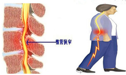 椎管狭窄的症状.jpg 椎管狭窄的症状.jpg