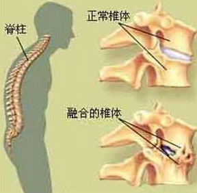 强直性脊柱炎的症状.jpg 强直性脊柱炎的症状.jpg