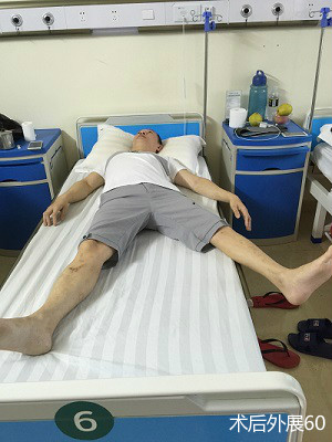 术后外展60°.jpg 术后外展60°.jpg