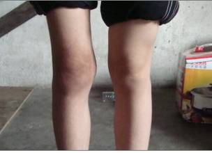 膝关节积水怎么治疗 膝关节积水怎么治疗
