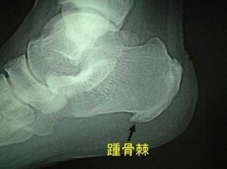 骨质增生 骨质增生