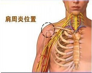 肩周炎 肩周炎