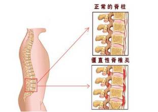强直性脊柱炎的前期症状介绍 强直性脊柱炎的前期症状介绍