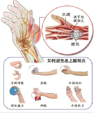 腱鞘炎结构图 腱鞘炎结构图