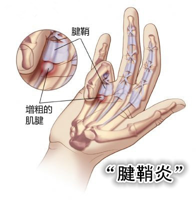 腱鞘炎 腱鞘炎