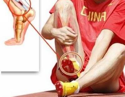 跟腱炎