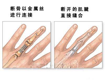 断指再植 断指再植