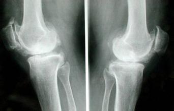 怎么做能减少骨质增生的危害