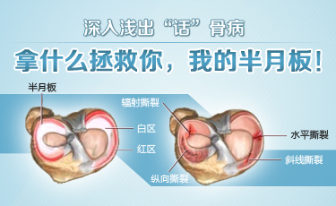 半月板损伤2.jpg