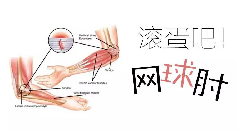 网球肘原因.jpeg 网球肘原因.jpeg