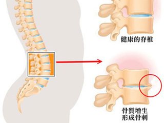 骨质增生危害.jpg 骨质增生危害.jpg