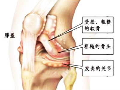 滑膜炎的症状.jpg 滑膜炎的症状.jpg