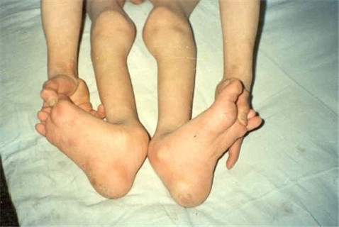 儿童类风湿性关节炎.jpg 儿童类风湿性关节炎.jpg