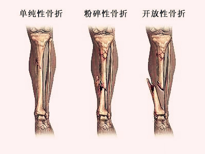 骨折的症状.jpg 骨折的症状.jpg