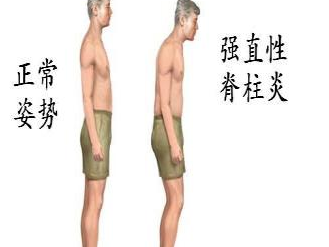 强直性脊柱炎症状.jpg 强直性脊柱炎症状.jpg