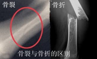 骨裂和骨折的区别.jpg 骨裂和骨折的区别.jpg