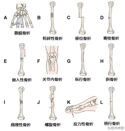骨折常见类型.jpg 骨折常见类型.jpg