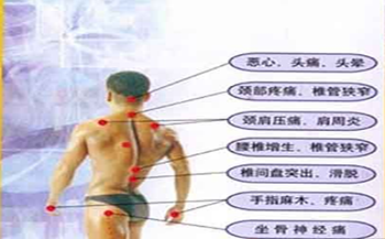 骨质增生于运动.png 骨质增生于运动.png