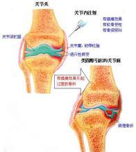 骨性关节炎2.jpg 骨性关节炎2.jpg