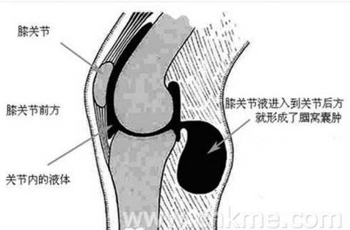 滑膜炎多发疾病.jpg 滑膜炎多发疾病.jpg