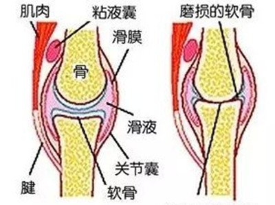 滑膜炎的症状.jpg 滑膜炎的症状.jpg