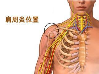 肩周炎是不是就是肩膀疼.jpg 肩周炎是不是就是肩膀疼.jpg