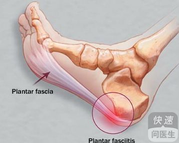 脚后跟肿和强直性脊柱炎的关系.jpg 脚后跟肿和强直性脊柱炎的关系.jpg