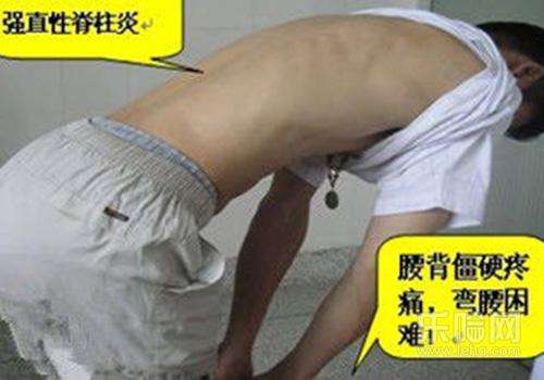 解开强制性脊柱炎之谜.jpg 解开强制性脊柱炎之谜.jpg