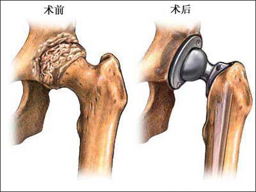 类风湿骨头坏死.jpg 类风湿骨头坏死.jpg