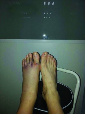 脚趾骨折症状表现.jpg 脚趾骨折症状表现.jpg