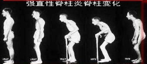 强直性脊柱炎有哪些危害.jpeg 强直性脊柱炎有哪些危害.jpeg