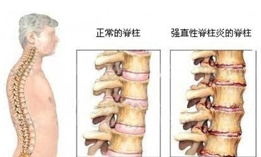 强直性脊柱炎症状.jpg 强直性脊柱炎症状.jpg