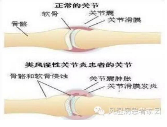 确诊类风湿性关节炎需要做些什么检查.png 确诊类风湿性关节炎需要做些什么检查.png
