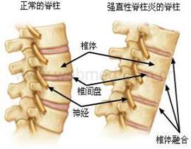 强直性脊柱炎的症状.jpg 强直性脊柱炎的症状.jpg