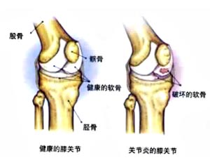 膝盖不受力是不是膝关节炎.jpg 膝盖不受力是不是膝关节炎.jpg