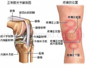 膝关节半月板损伤怎么诊断.jpg 膝关节半月板损伤怎么诊断.jpg