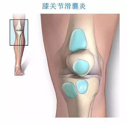 膝关节滑膜炎是怎样造成的.jpg 膝关节滑膜炎是怎样造成的.jpg