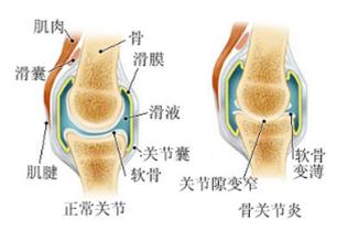 膝关节骨性关节炎的原因.jpg 膝关节骨性关节炎的原因.jpg