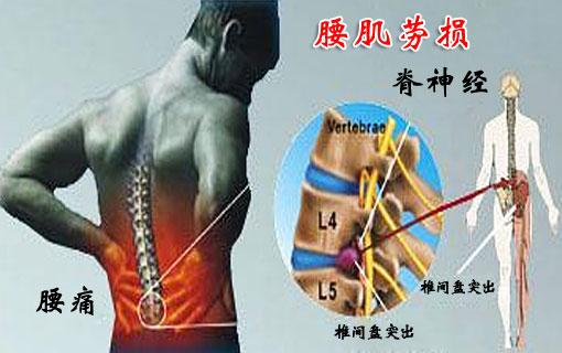 腰肌劳损的症状判断.jpg 腰肌劳损的症状判断.jpg