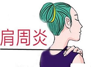 肩周炎5.jpg 肩周炎5.jpg